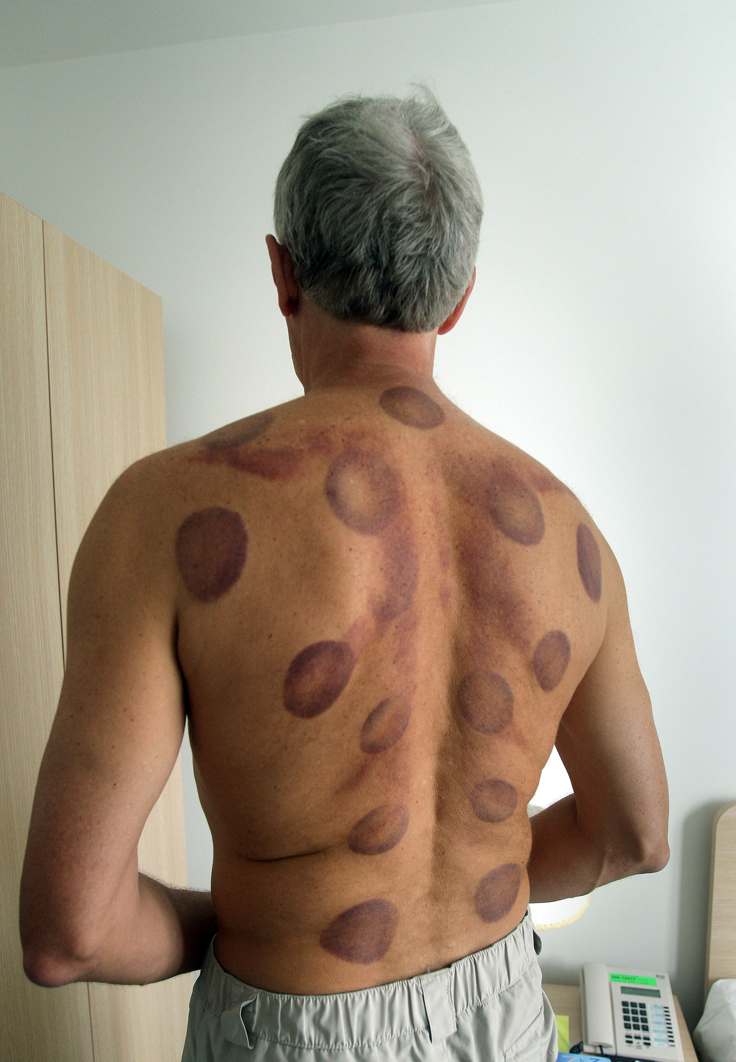 Scott Ostler after having a major cupping while covering the 2008 Beijing Olympics, in China, on August 6, 2008. | Source: Getty Images