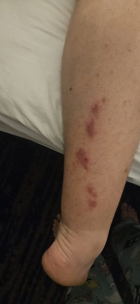 Jones' rash on the back of his legs.